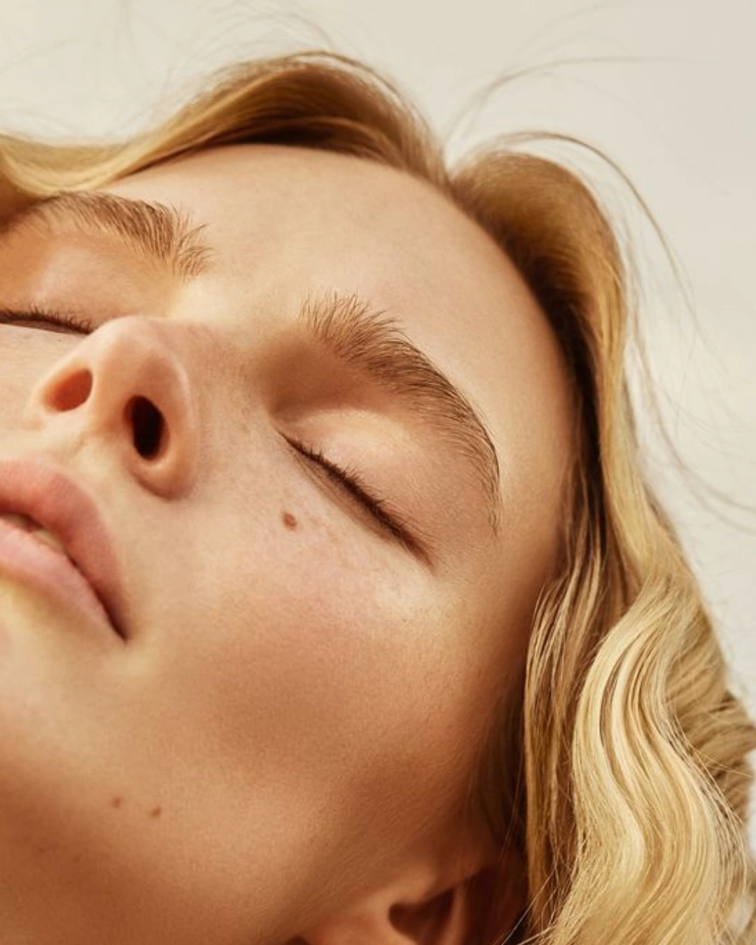 Acne e Cicatriz